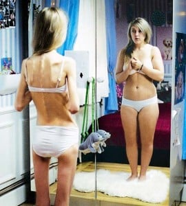 anorexia