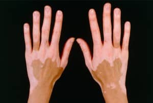 Vitiligo-20151120032238430