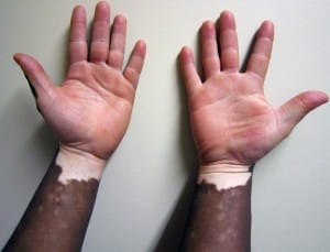 Vitiligo1