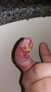 Dedo esporotricose